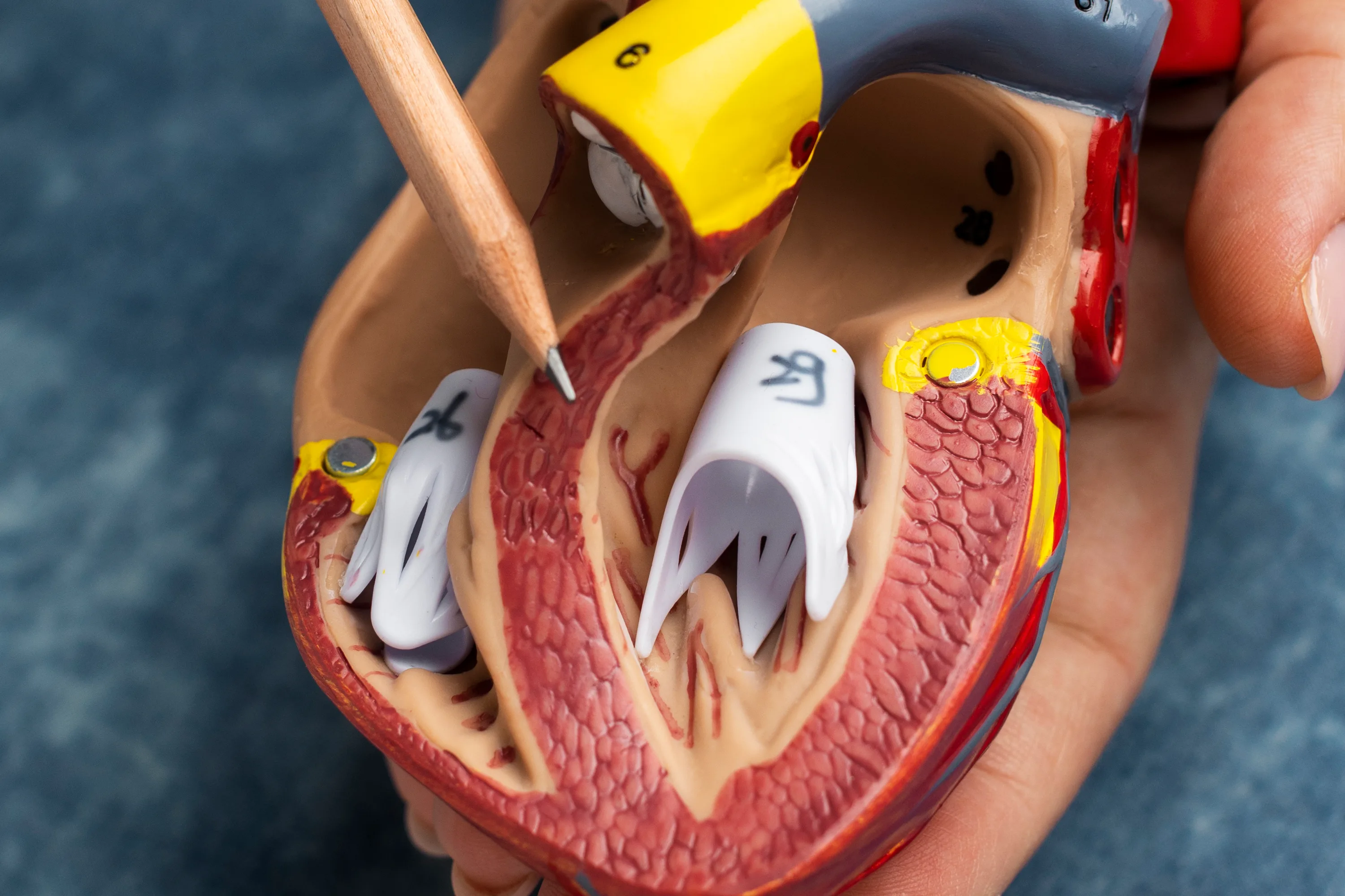 Implante de TAVI (Implante transcatéter de válvula aórtica) en CDMX: Procedimiento mínimo invasivo